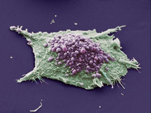 2009最佳医学摄影揭晓：肺癌细胞培基长出的单细胞