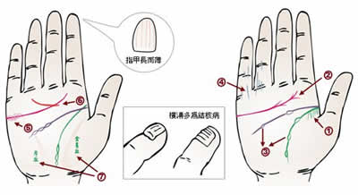 24种手相揭示身心健康问题