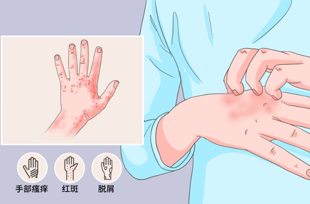 手部湿疹如何治疗？